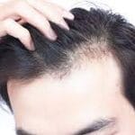 Custom compounded hair loss treatment prepared at a compounding pharmacy in Etobicoke for pattern hair loss