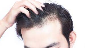 Custom compounded hair loss treatment prepared at a compounding pharmacy in Etobicoke for pattern hair loss